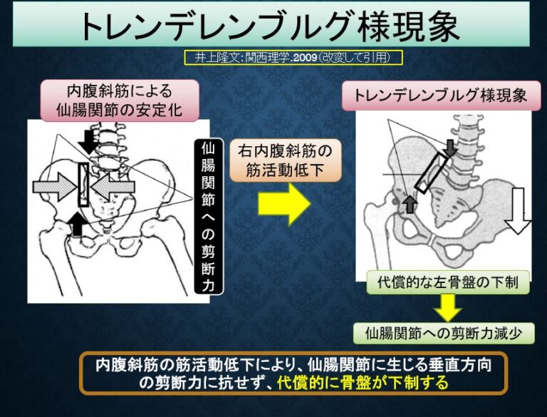 『トレンデレンブルグ徴候とトレンデレンブルグ様徴候？』 | 運動器リ …